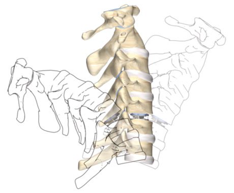 Rotaio Artificial Disc