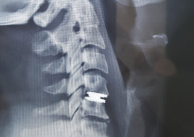 Cervical Disc replacement